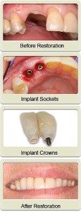 before-after-teeth-implants Before and After Implants Placement