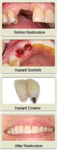 Before and After Implants Placement