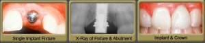 Single dental implant